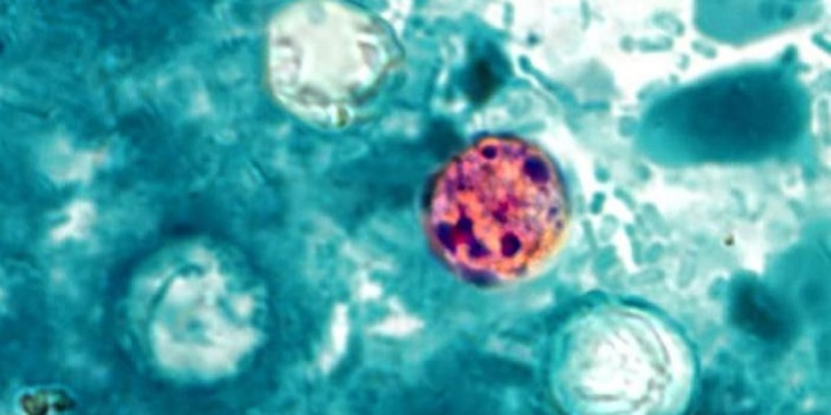 Louisiana Cyclospora cases slightly above average, doctor says