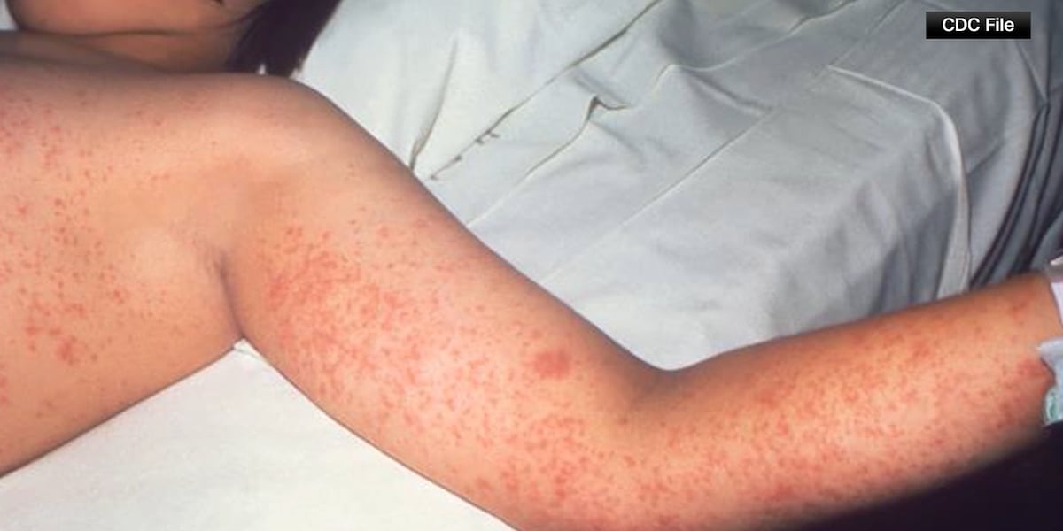 The US surpasses 1,000 measles cases due to 11 states actively occurring The US surpasses 1,000 measles cases due to 11 states actively occurring