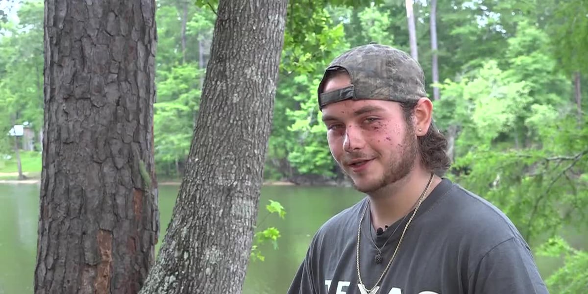 'Unluckiest lucky man alive': Man survive lightning strike