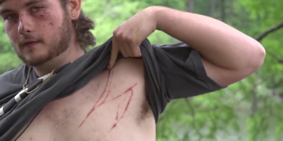 Teen survives lightning strike